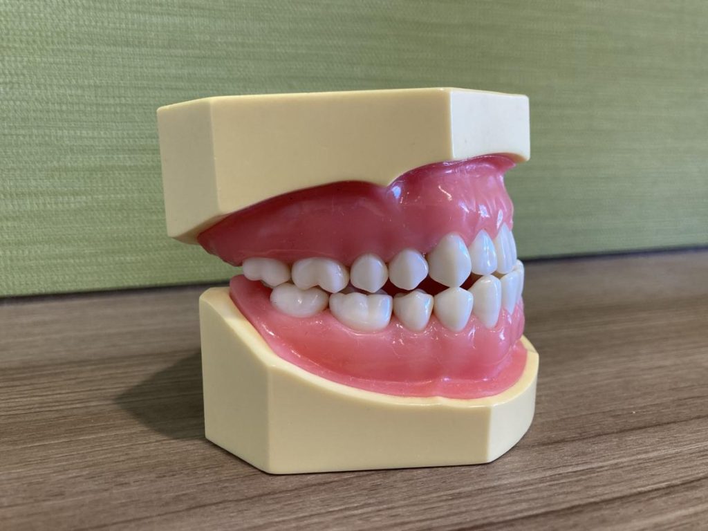 小児矯正-受け口 - 小児矯正は北海道北広島市にある歯医者のさいわいデンタルクリニック札幌大曲