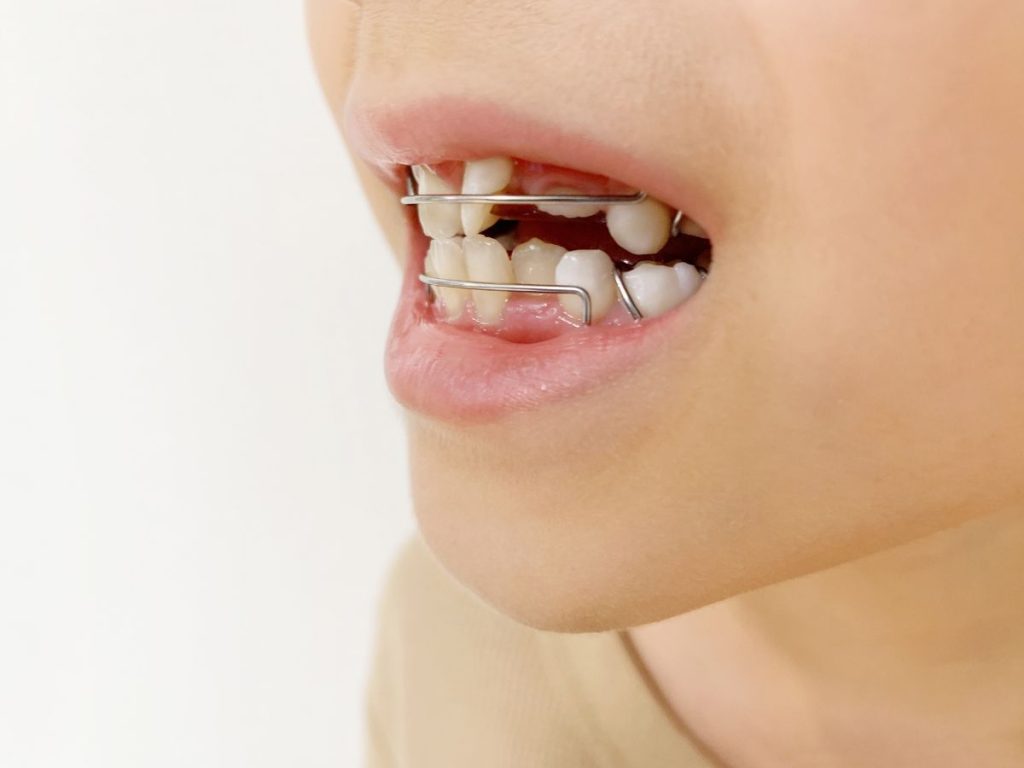 小児矯正 幼児 - 小児矯正は北海道北広島市にある歯医者のさいわいデンタルクリニック札幌大曲