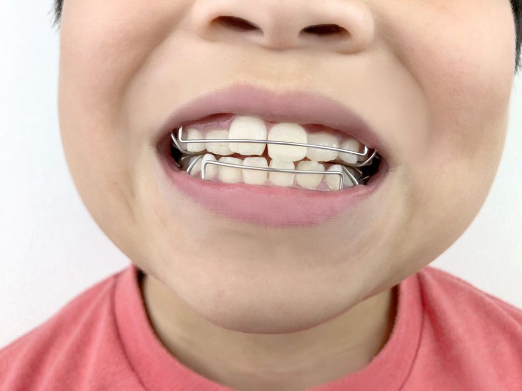 小児矯正-通う頻度- - 小児矯正は北海道北広島市にある歯医者のさいわいデンタルクリニック札幌大曲