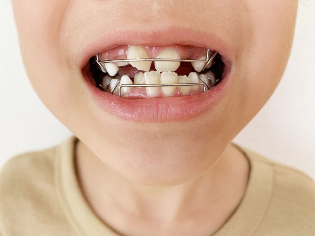 東旭川駅-小児矯正-必要性 - 小児矯正は北海道北広島市にある歯医者のさいわいデンタルクリニック札幌大曲