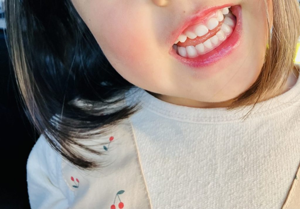 24緑ヶ丘_小児矯正 - 小児矯正は北海道北広島市にある歯医者のさいわいデンタルクリニック札幌大曲