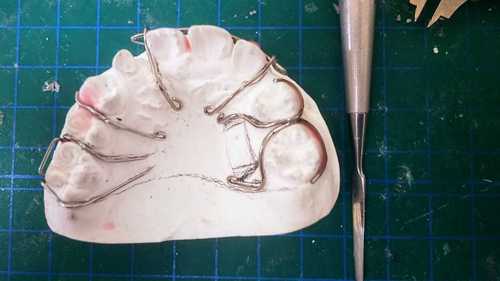 01小児矯正 リンガルアーチ - 小児矯正は北海道北広島市にある歯医者のさいわいデンタルクリニック札幌大曲