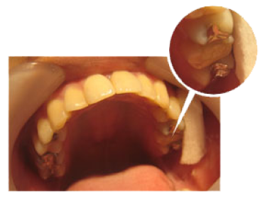 さいわいデンタルクリニック ラバーダム治療 防湿を行う前