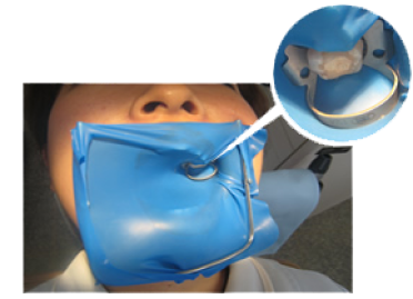 さいわいデンタルクリニック ラバーダム治療 防湿を行っている様子