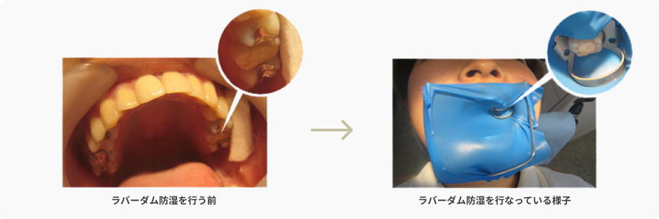 さいわいデンタルクリニック ラバーダム治療 防湿