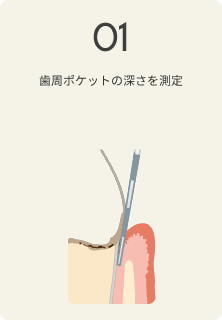 さいわいデンタルクリニック 歯周病の治療の流れ 歯周ポケットの深さを測定