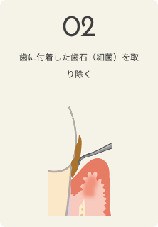 さいわいデンタルクリニック 歯周病の治療の流れ 歯に付着した歯石（細菌）を取り除く
