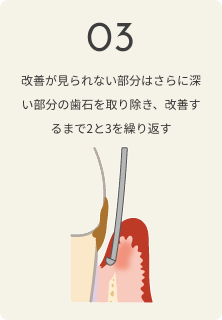 さいわいデンタルクリニック 歯周病の治療の流れ 改善が見られない部分はさらに深い部分の歯石を取り除く