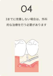 さいわいデンタルクリニック 歯周病の治療の流れ 改善しない場合は外科的な治療を行う