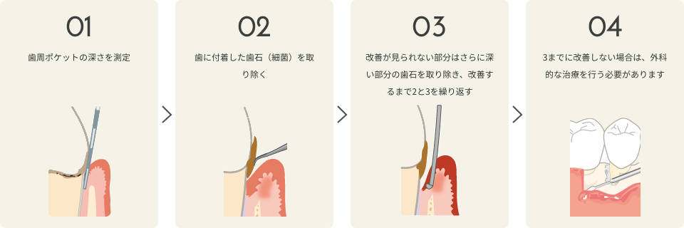 さいわいデンタルクリニック 歯周病の治療の流れ