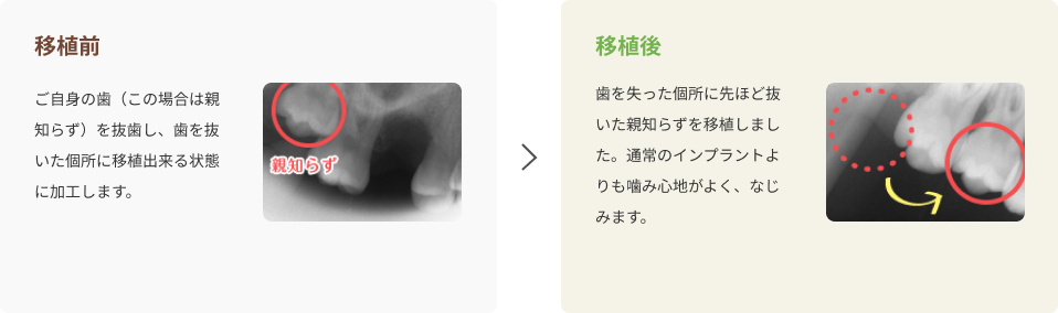 さいわいデンタルクリニック 歯の移植・再植 治療の流れ