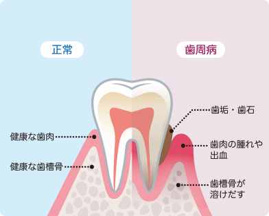 さいわいデンタルクリニック 歯茎が腫れた・痩せた 歯周病